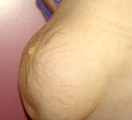 Abdominoplastie9-voor